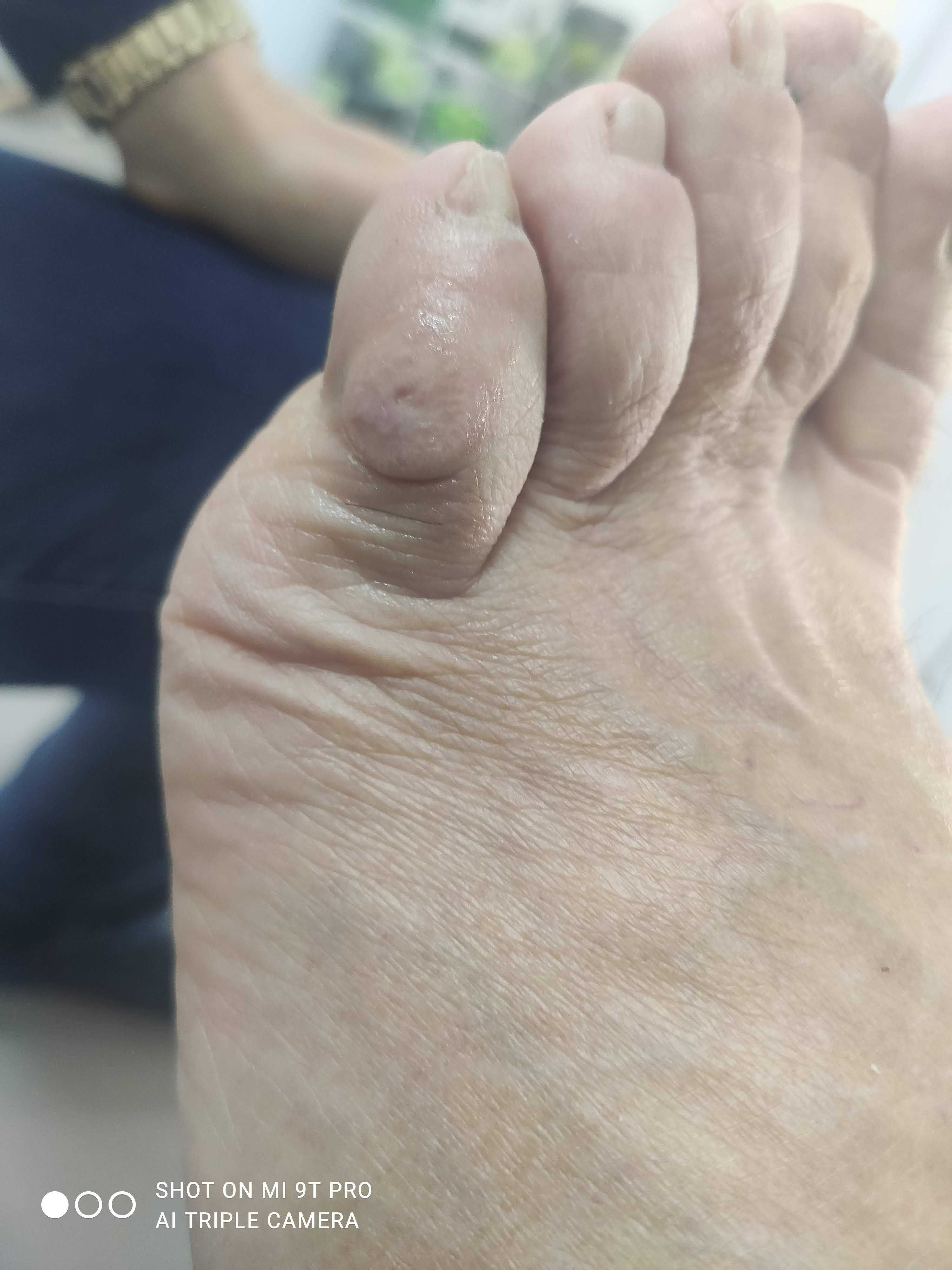 TRATAMENTO DE CALOS/UNHAS ENCRAVADAS (masculino/feminico)