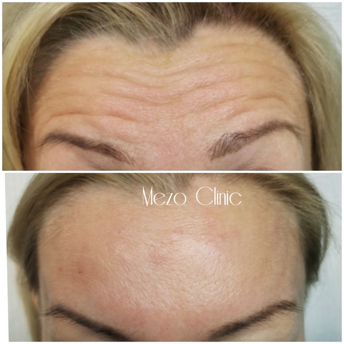 -10/procent na wszystkie zabiegi. Botox ,powiększanie ust .