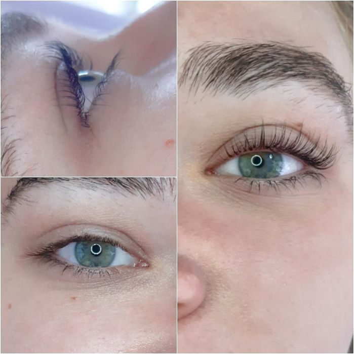 Stymulatory Biorewitalizatory Dermapen Mezoterapia Btx effect