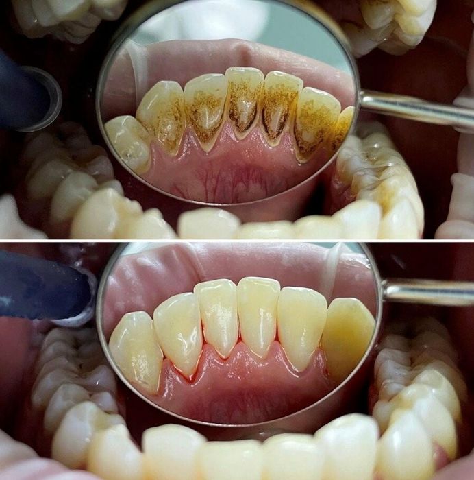 Професійна гігієна порожнини рота