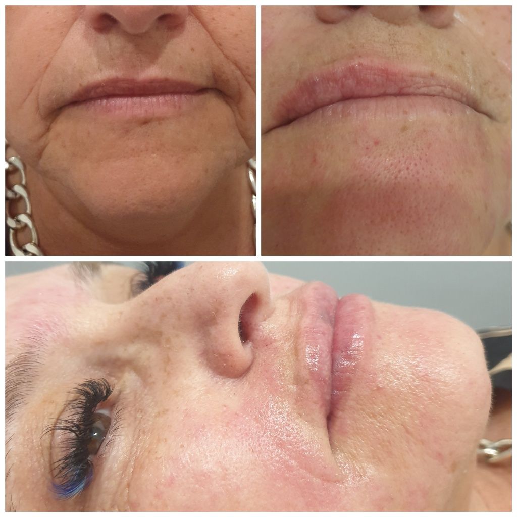 Preenchimento labial e harmonização facial e Lipo enzimática