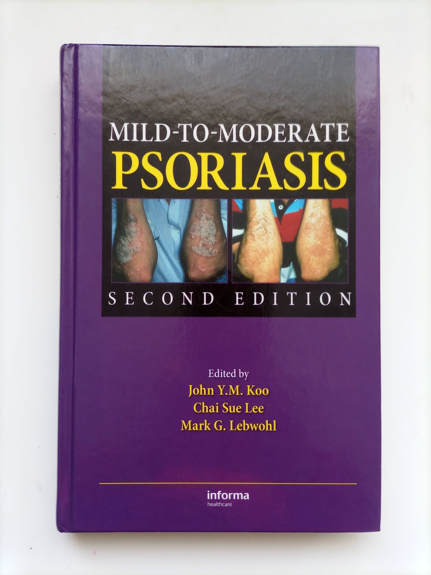 NOWA John Koo Lee Lebwohl Mild to moderate Psorasis