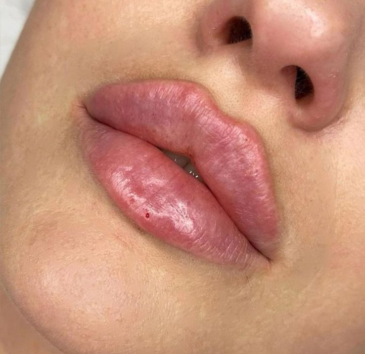 Увеличение губ - 1600. Колличество мест ограничено!