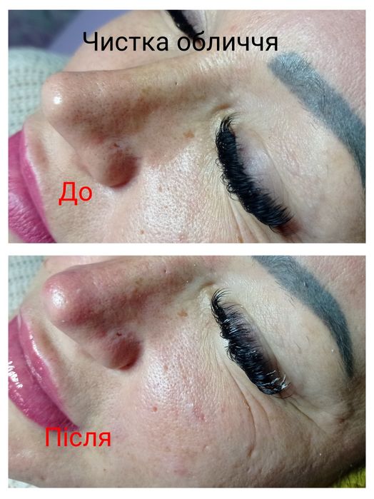 Косметолог Кривой Рог(губы, ботокс,чистка лица)