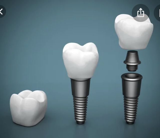 IMPLANTES DE DENTES   em várias tranches        varios pagamentos um  sorriso e expressao facial de excelência