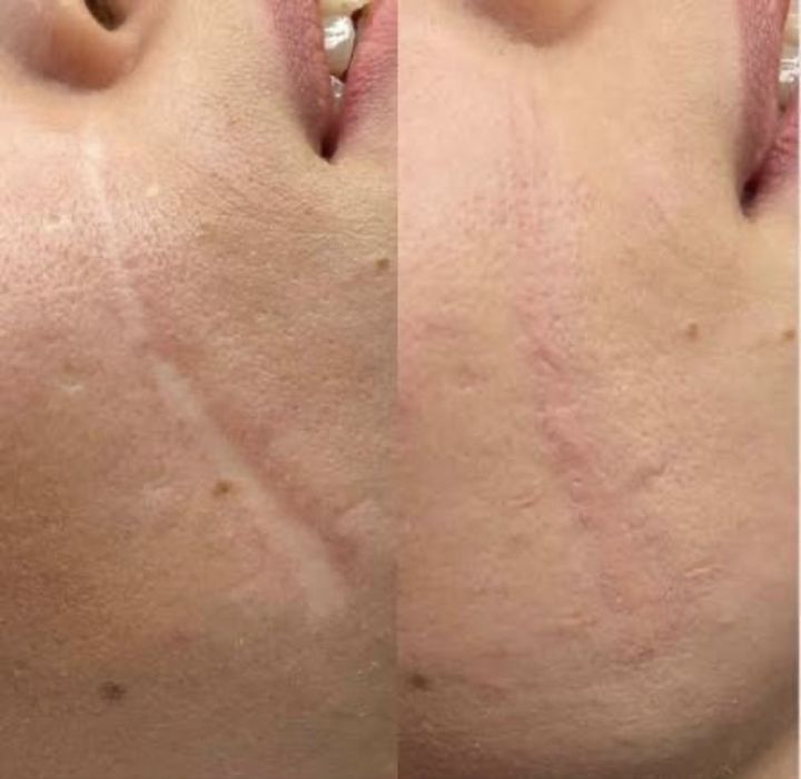 Мікроліндінг-Видалення шрамів-Рубці-Розтяжки