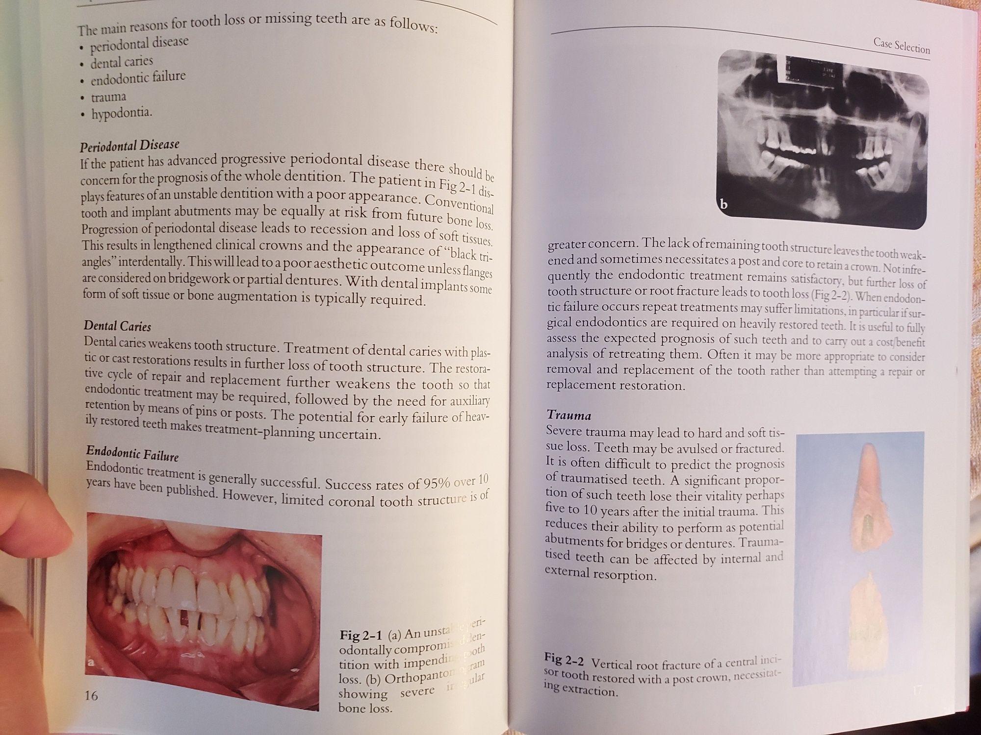 Livro de implantes dentários para generalistas.