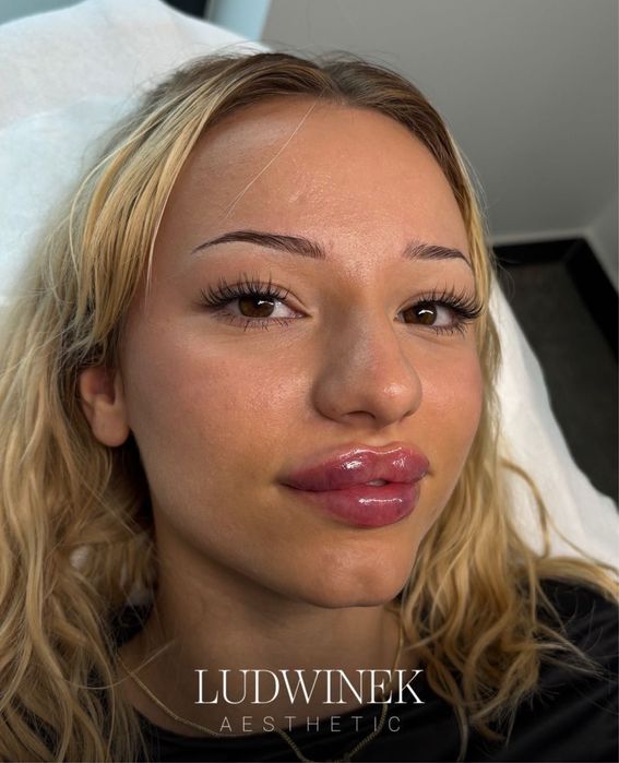 490 zł  Powiększanie i modelowanie ust medycyna estetyczna Kielce