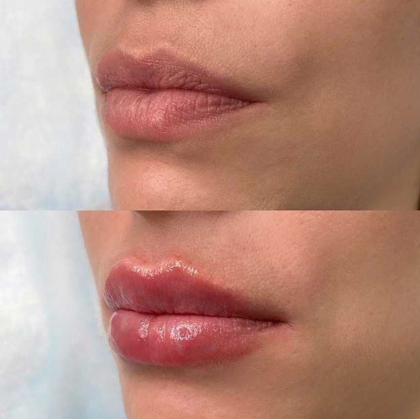 Современная косметология: увеличение губ, контурная пластика, Ботокс.