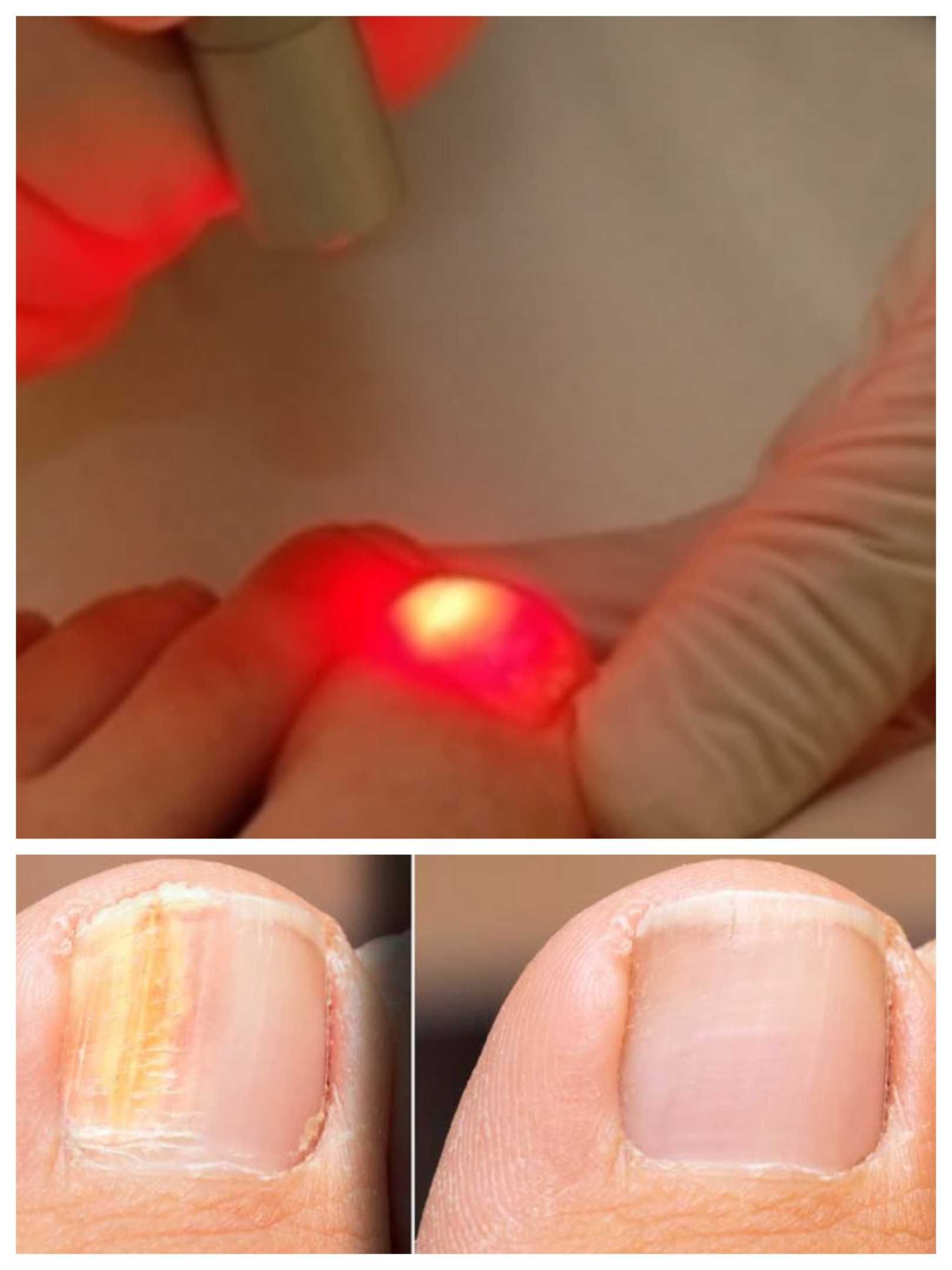 Tratamento a laser fungos mãos e pés