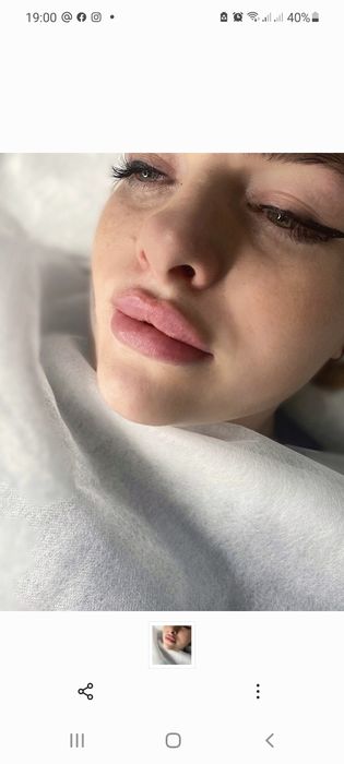 Пластика губ .Увеличение губ.Ботокс.