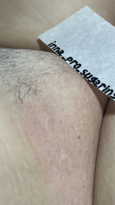 Депіляція Віск Шугарінг