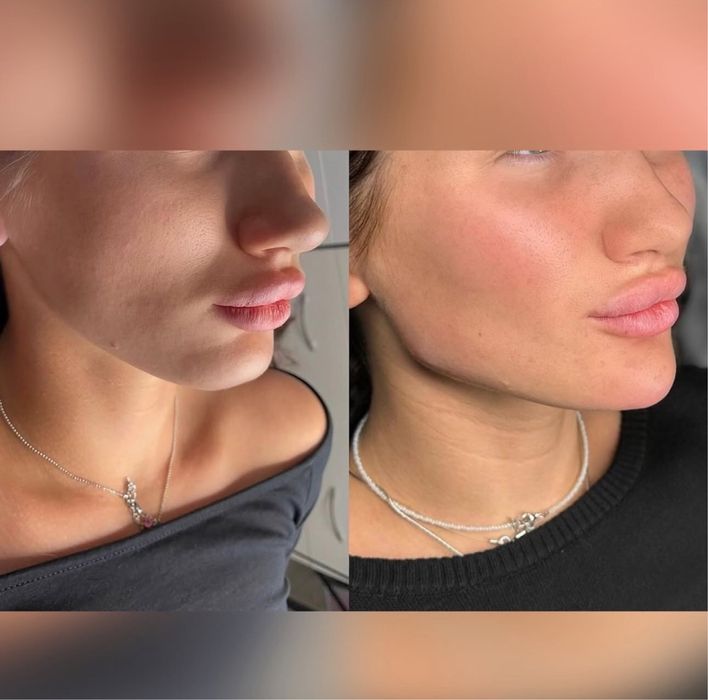 Акція на всю контурну пластику обличчя. Збільшення губ, ботокс, біо