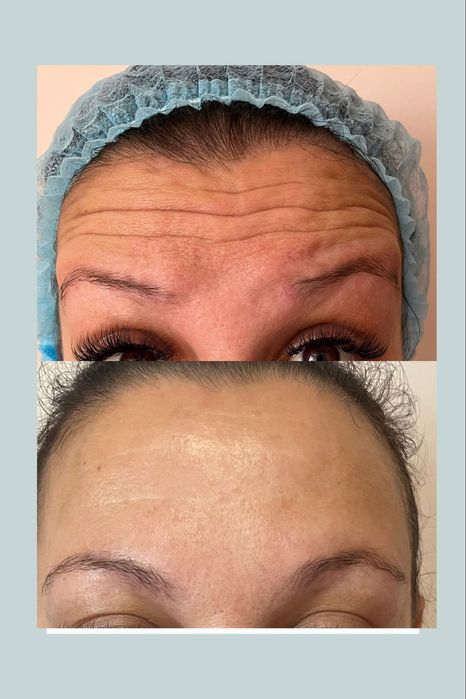 Косметолог/Ботокс Акция 1700 две зоны/Левый берег/