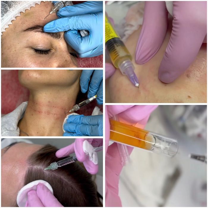 Акція!!! Плазмоліфтинг 1500 грн.