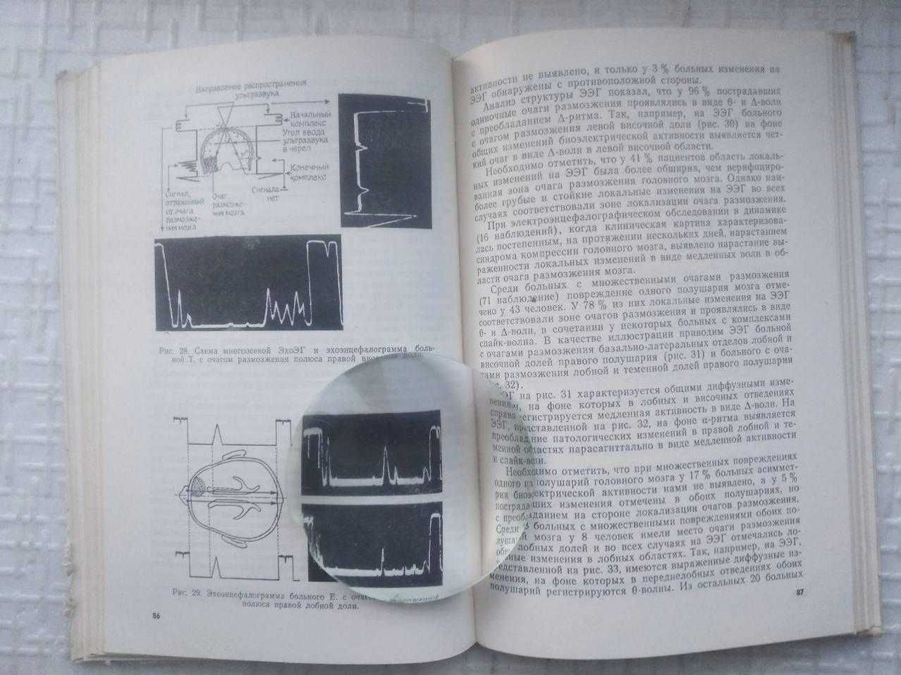 Хирургия травматических внутричерепных гематом и очагов размозжения го