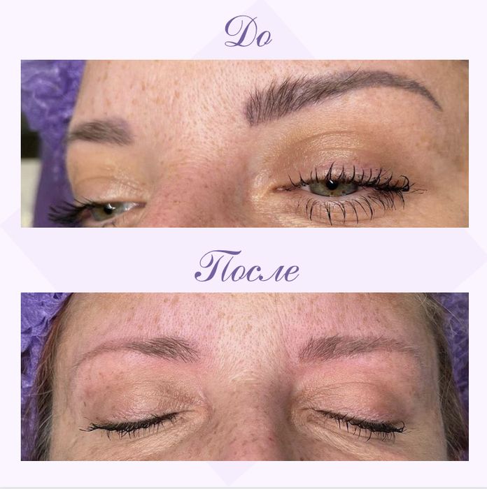 Видалення тату і перманентного макіяжу будь якої складності від 500грн