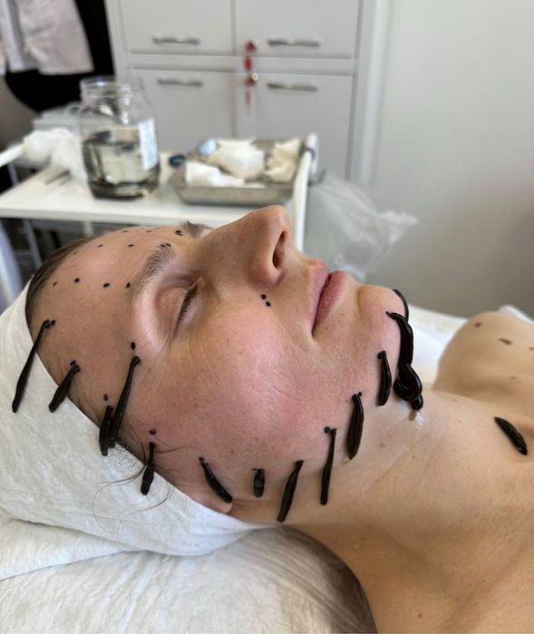 Гирудокосметология Пиявки Ксения Ангерова Мастер класс