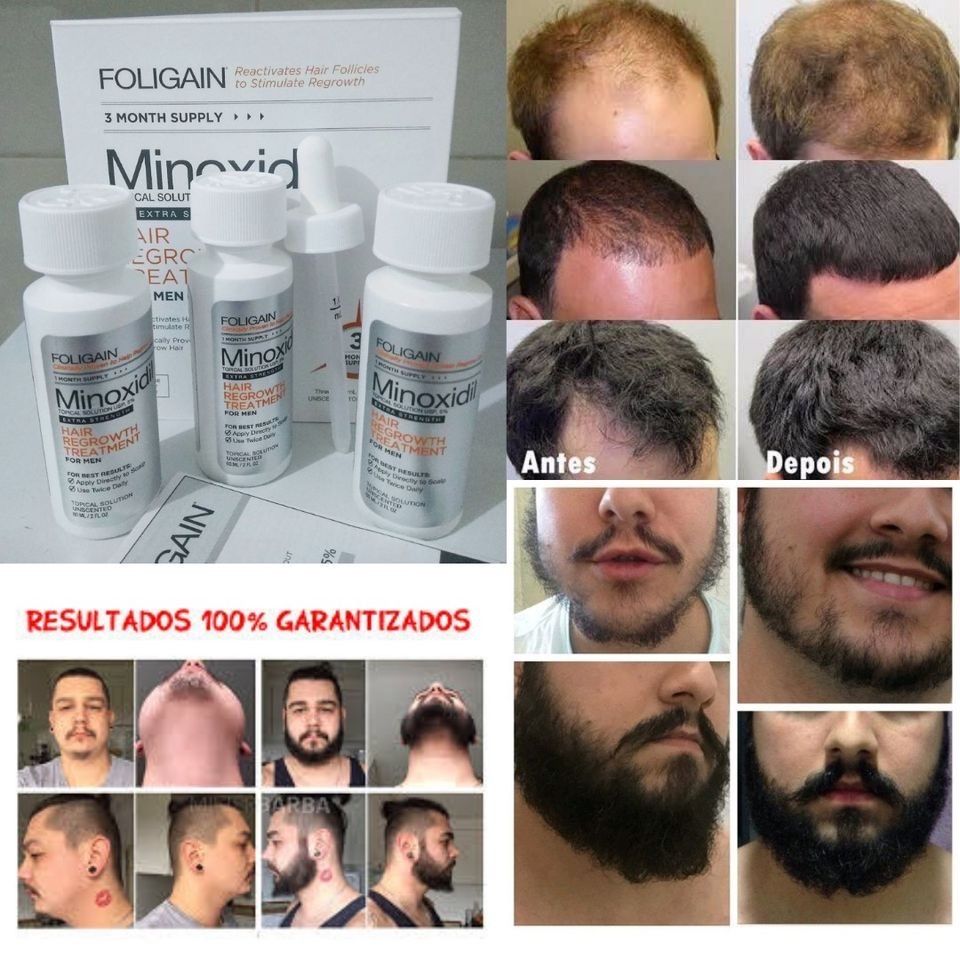 Minoxidil Foligain forte! Cabelo e barba de volta