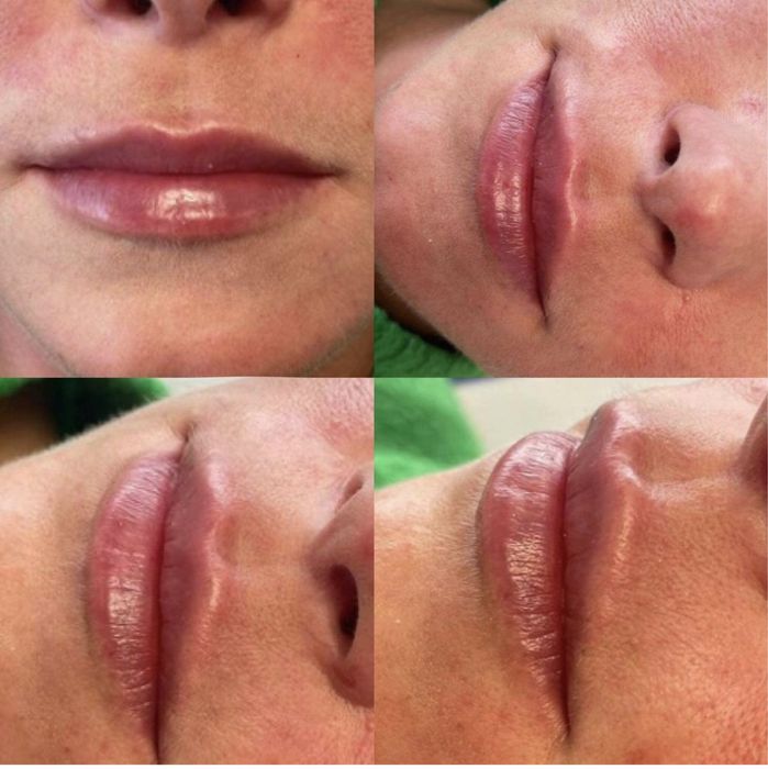 Btx ,Powiekszanie ust permanentny brwi i ust, stymulatory tkankowe