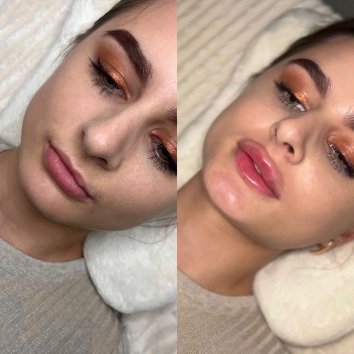 Модель на губы  ботокс Угли Джоли скули