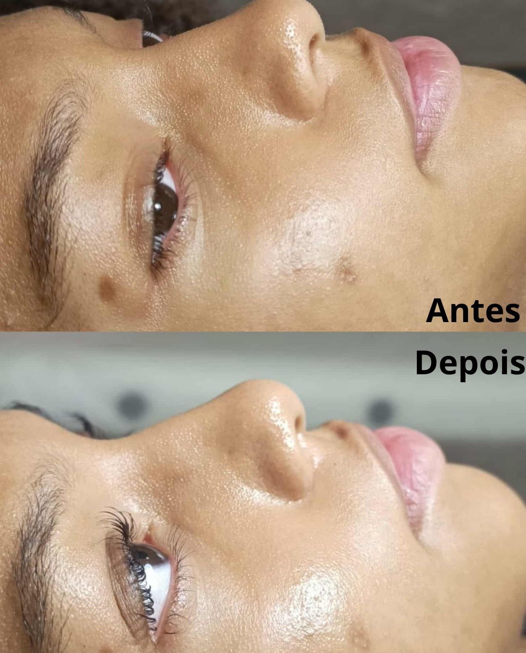 Depilação a Laser e Lifting