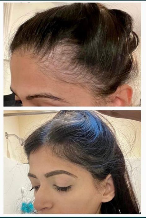 Корейський засіб для росту і проти випадіння волосся