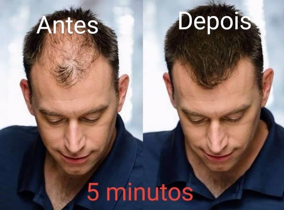 Fibras Toppik para calvície instantâneo