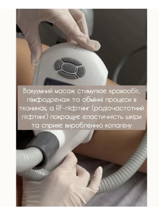 Антицелюлітний апаратний масаж з RF ліфтингом