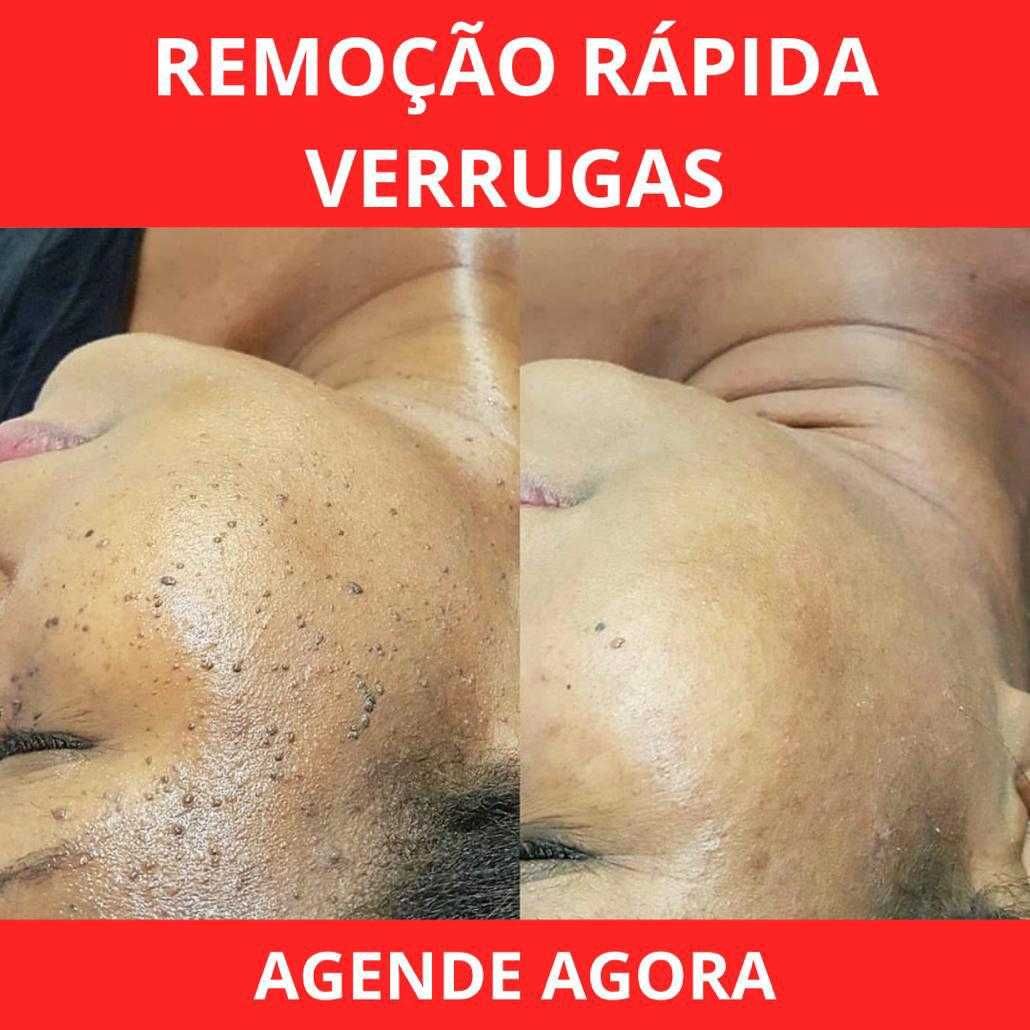 Remoção de verrugas de todos os tipos