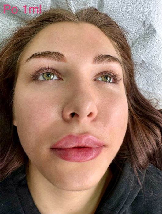 Super Promocja 450zł Modelowanie powiększanie ust wyrównanie asymetrii