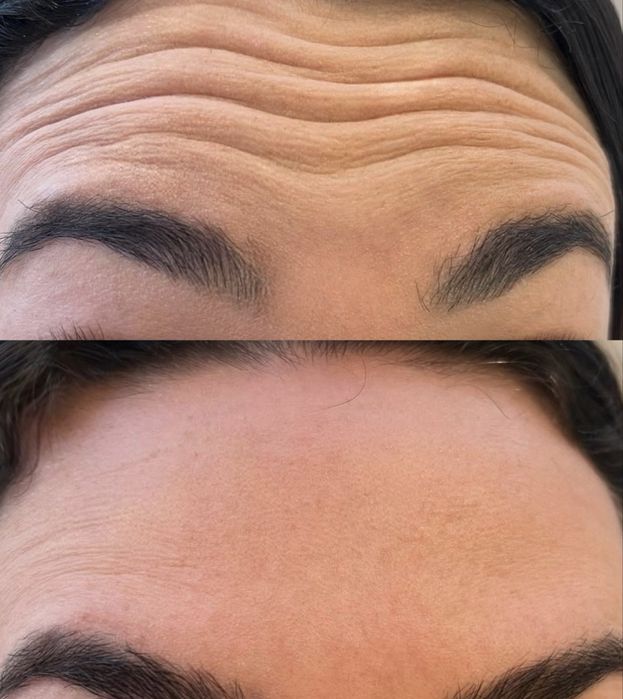 Ботокс.Увеличение губ.Гипергидроз