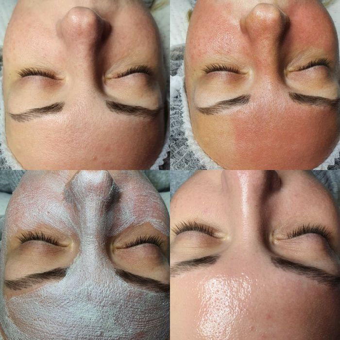 Косметолог - естетист з вищою медичною освітою, консультації по акне,