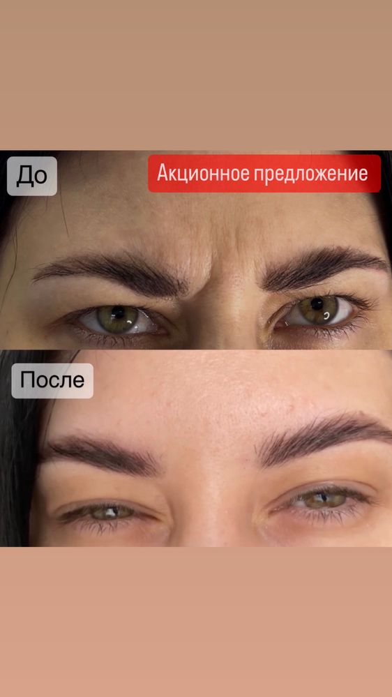 Ботокс |центр|1400/зона
