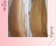 Depilação à laser, estética, massagens/tratamento corporal