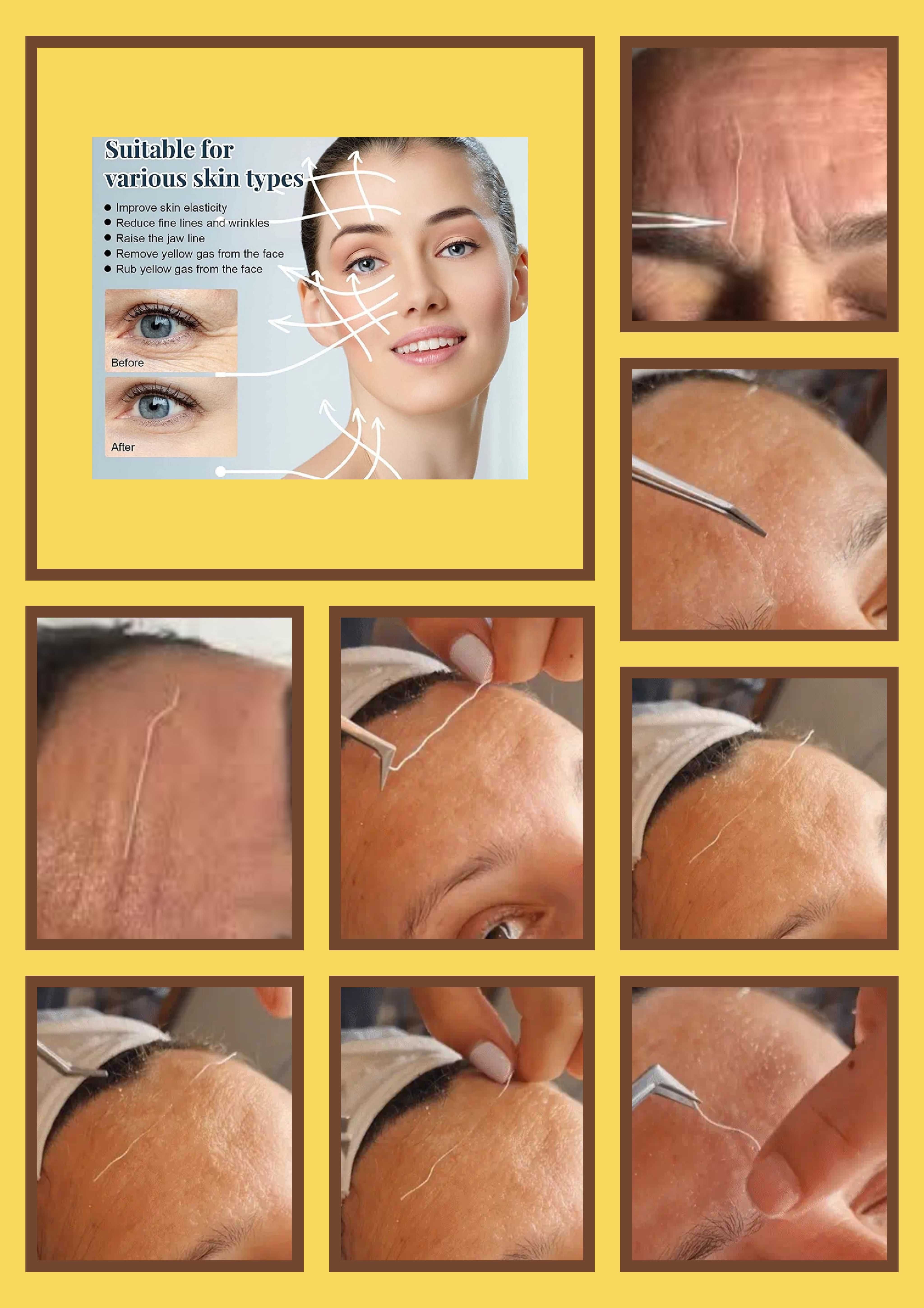 Sessão blooming skin na Pontinha ,cavitação,criofrequência etc