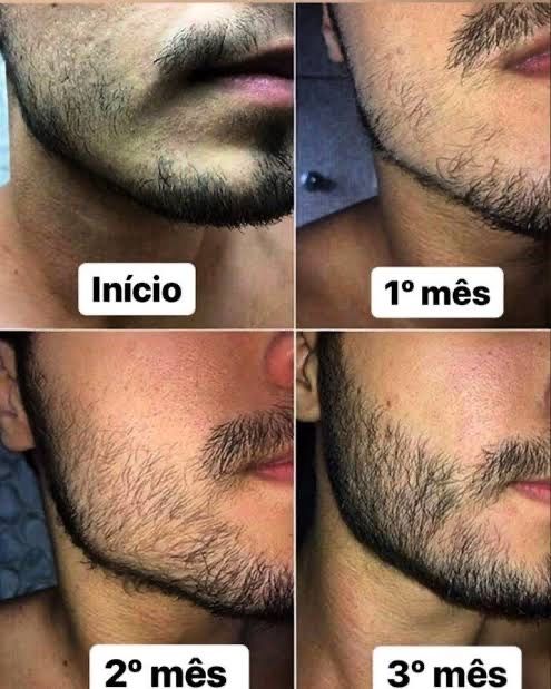 Minoxidil foligain fim da calvicie/ crescimento barba