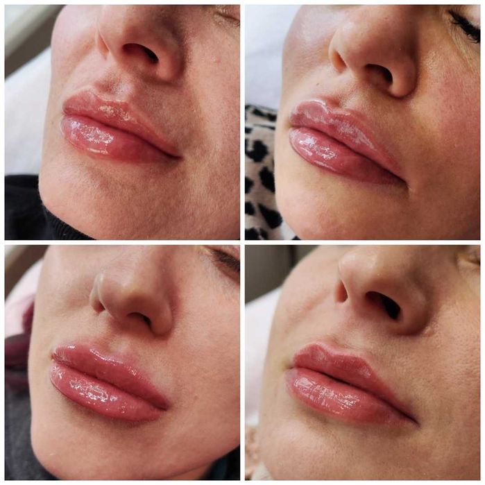 Увеличение губ, контурная коррекция