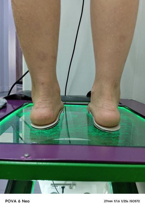 Ортопедичні устілки індивідуального виготовлення