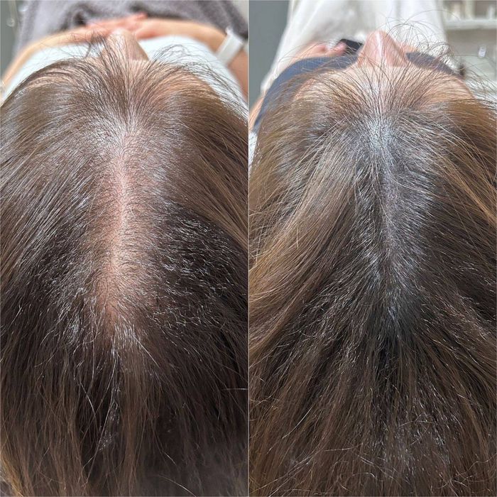 Трихолог, випадіння волосся, алопеція, пілінг шкіри голови, лупа