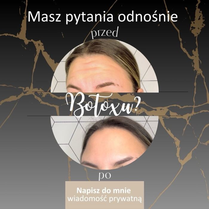 Uslugi medycyny estetycznej (botoks, stymulatory, kwas hialuronowy)