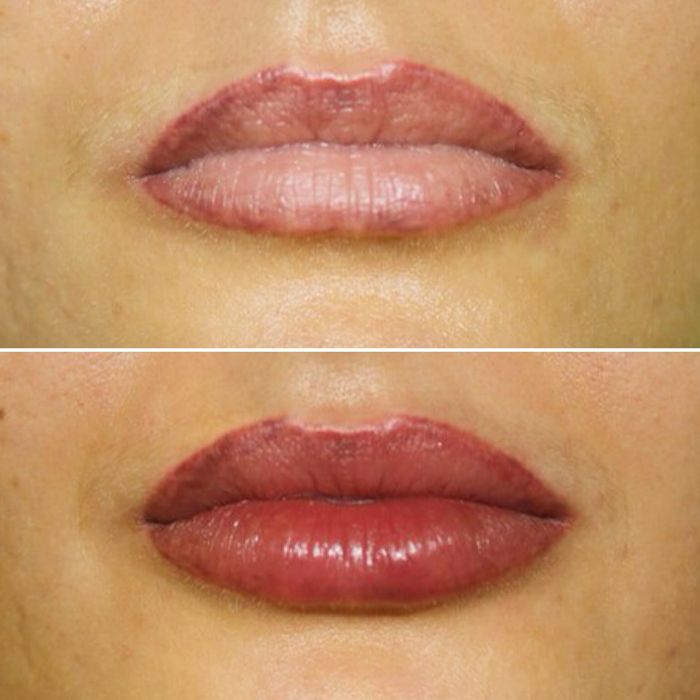 Губи та Ботокс  Новорічні знижки !!!