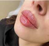 Powiekszanie ust PROMOCJA 299 zl !!! Botox 200 zl