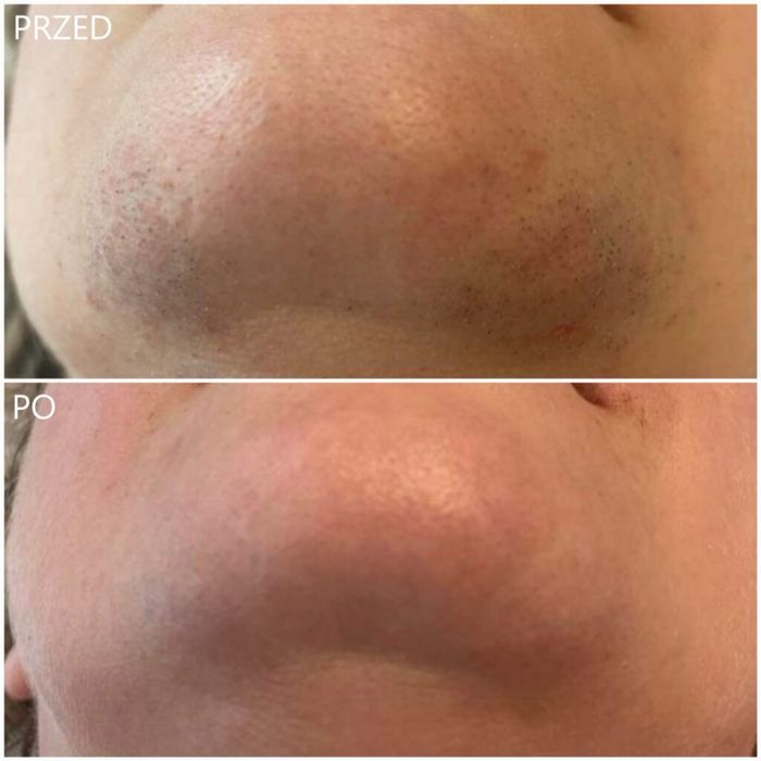 Zabieg Depilacji Laserowej / Endermologii -30% na wszystko