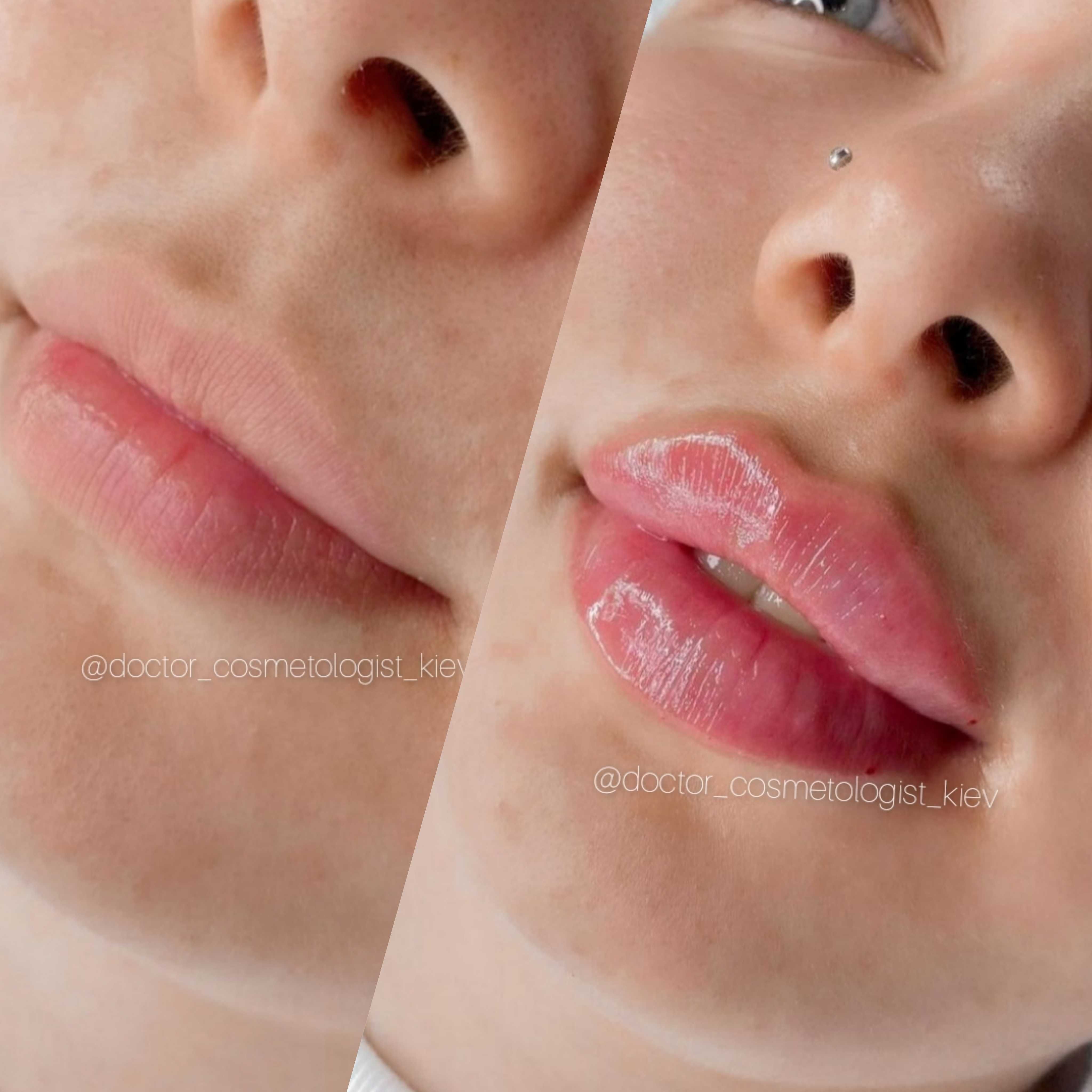 Лікар косметолог ботокс збільшення губ  контурна пластика київ центр