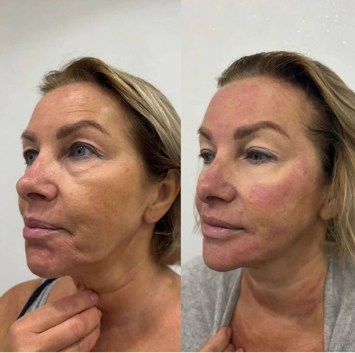 Косметолог Николаев ,губы 3500,ботокс биоревитализация