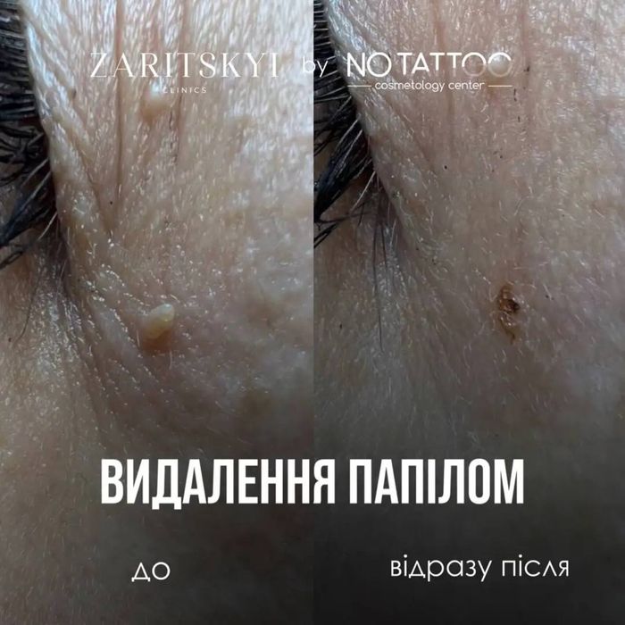 Лазерне видалення папілом