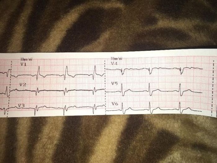 Кардиограмма на дому