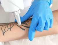 Modelo para remoção de tatuagem