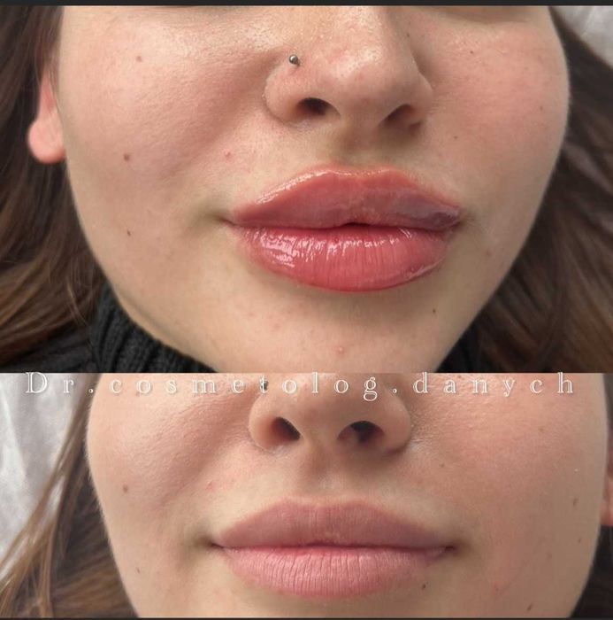 Лікар косметолог. БОТОКС . Ін'єкції краси.